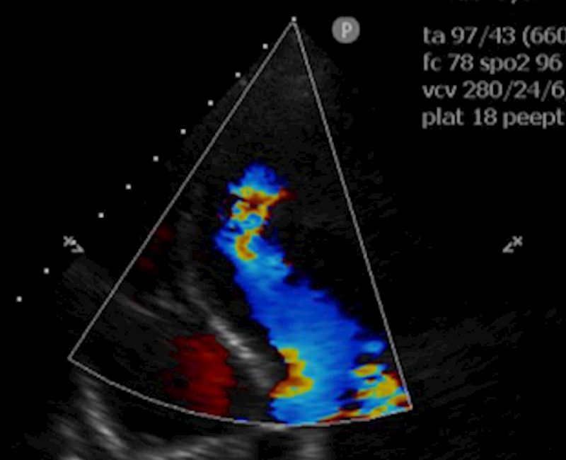 Cardiac involvement in a case of severe eosinophilic syndrome characterized by echocardiography